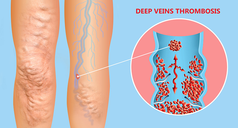 Deep Vein Thrombosis – Houston Vein Institute