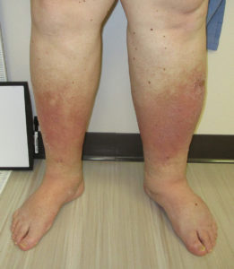 Leg Venous Insufficiency – Houston Vein Institute